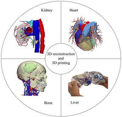 Application of three-dimensional technology in video-assisted thoracoscopic surgery sublobectomy